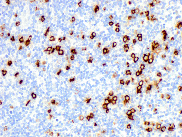 Lymph node biopsy shows that the neoplastic cells are positive for myeloperoxidase (400x).
